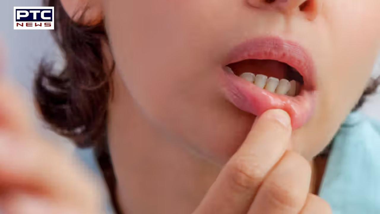 10 Effective Natural Remedies to Heal Mouth Ulcers